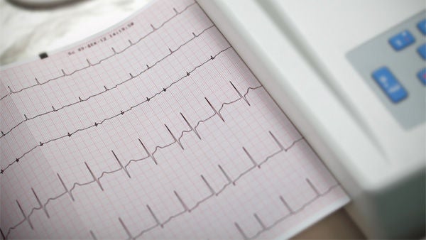 Ein EKG zeigt ein Vorhofflimmern. Bildquelle: sudok1