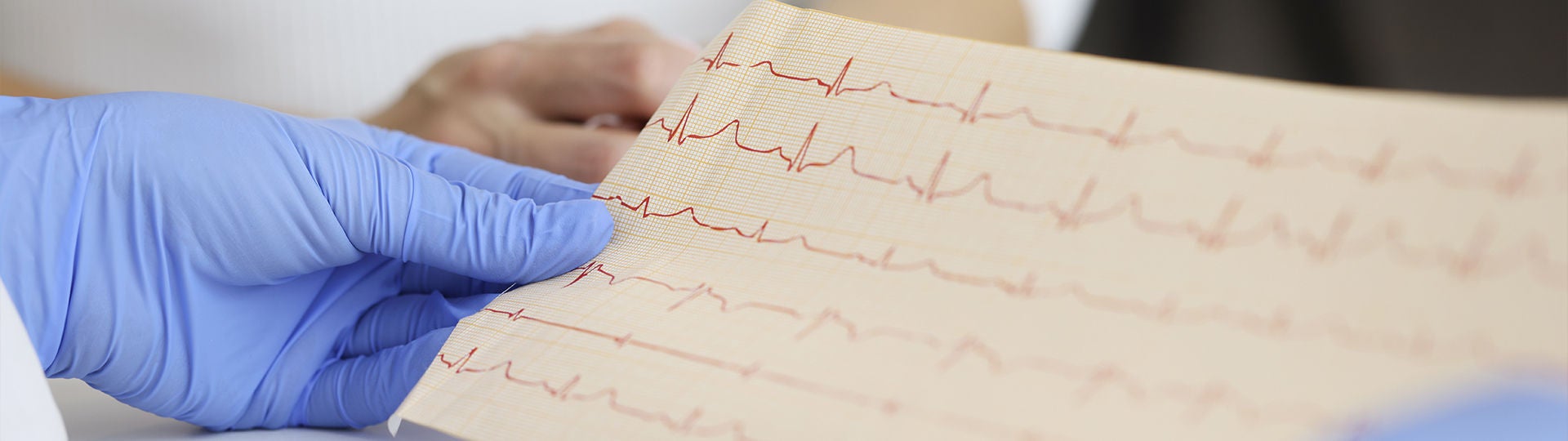 Ein EKG zeigt elektrische Signale des Herzens.
