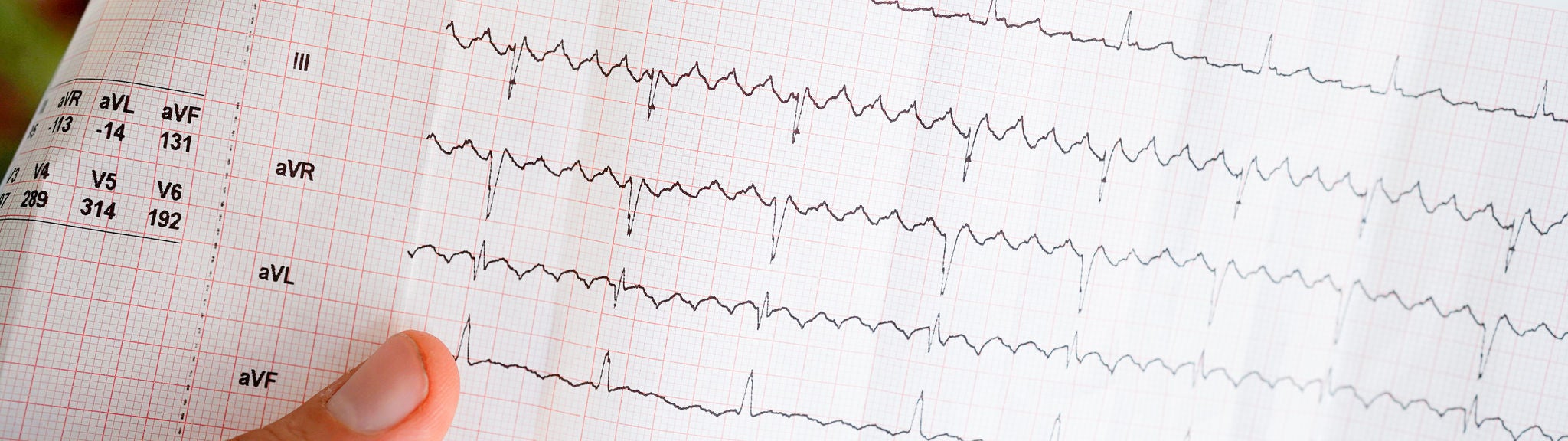 Eine EKG zeigt ein Vorhofflimmern.