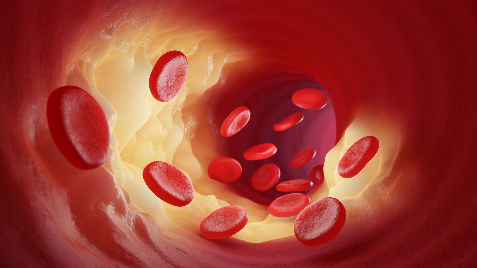 LDL-Cholesterin führt zu Verengungen in Blutgefäßen.