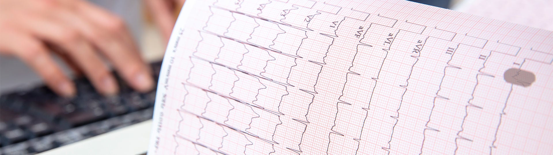 Ein EKG zeigt die elektrische Erregung des Herzens.