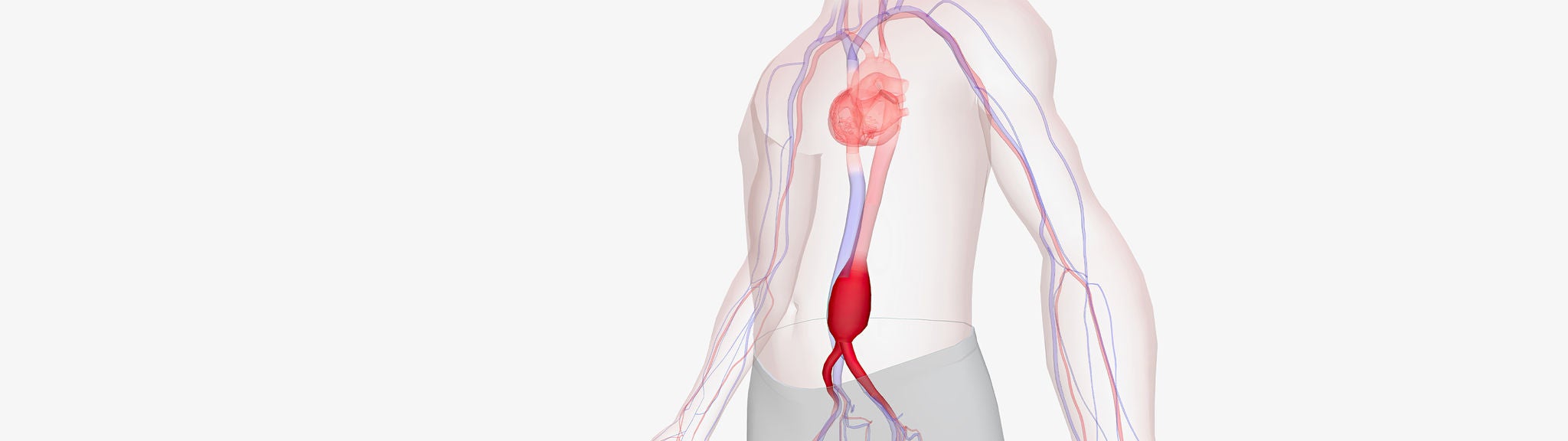 Eine Grafik zeigt eine Ausweitung der Hauptschlagader im Bauch.