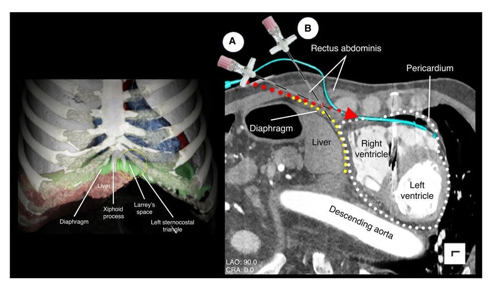 Epicardial ventricular arrhythmia ablation