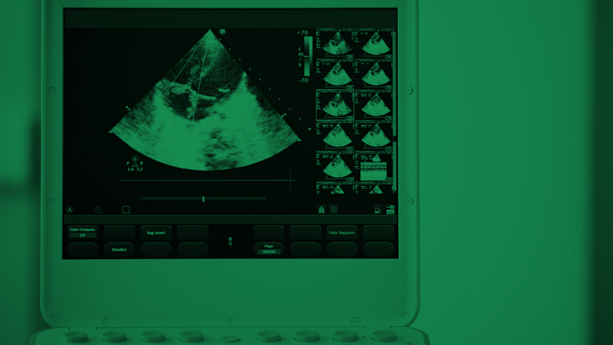 Bildschirm bei einer Echokardiographie