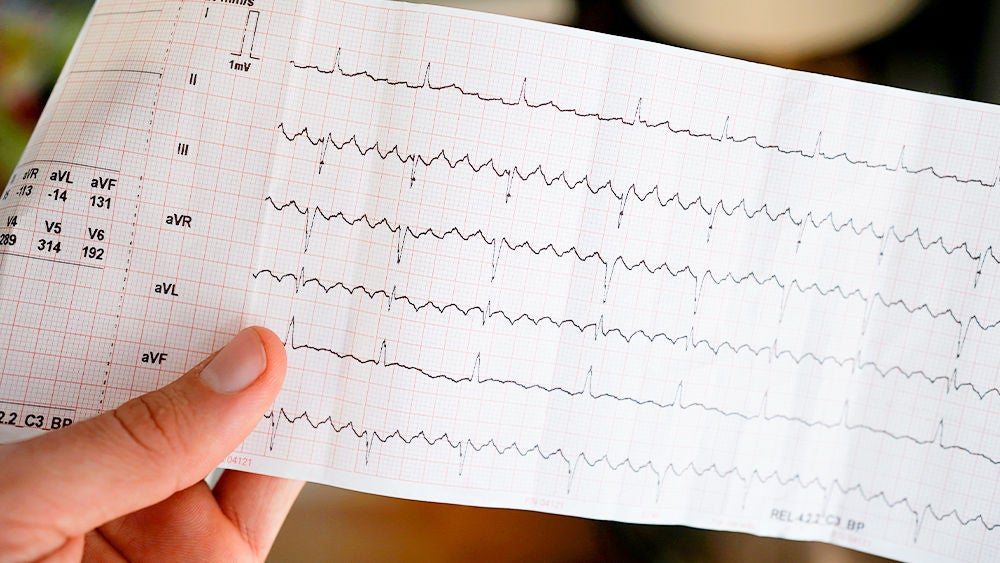 Vorhofflimmern: Symptome Der Herzrhythmusstörung