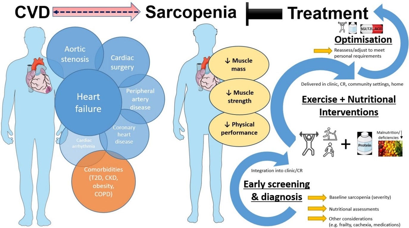 Exercise and Nutrition in Sarcopenia