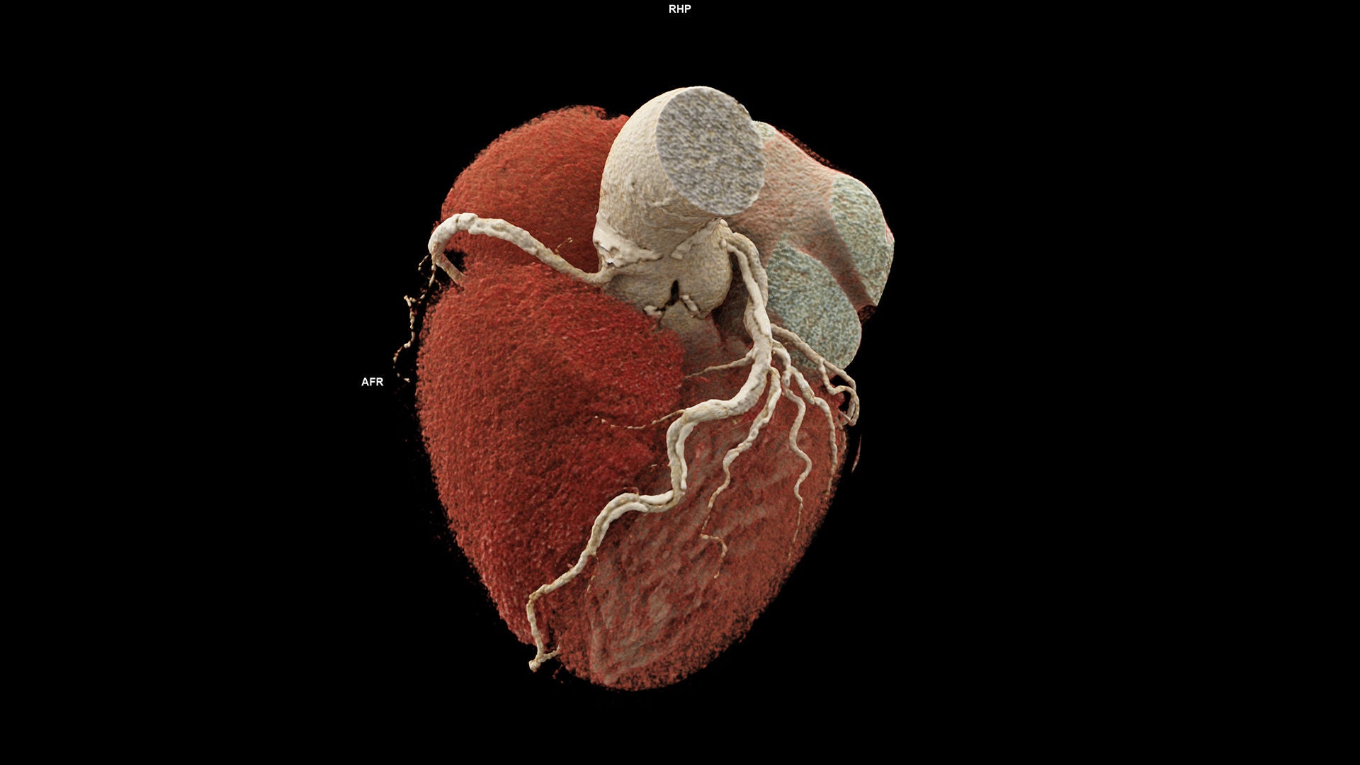 Dreidimensionale Aufnahme eines Herzens, aufgenommen mit photonzählender Computertomografie.