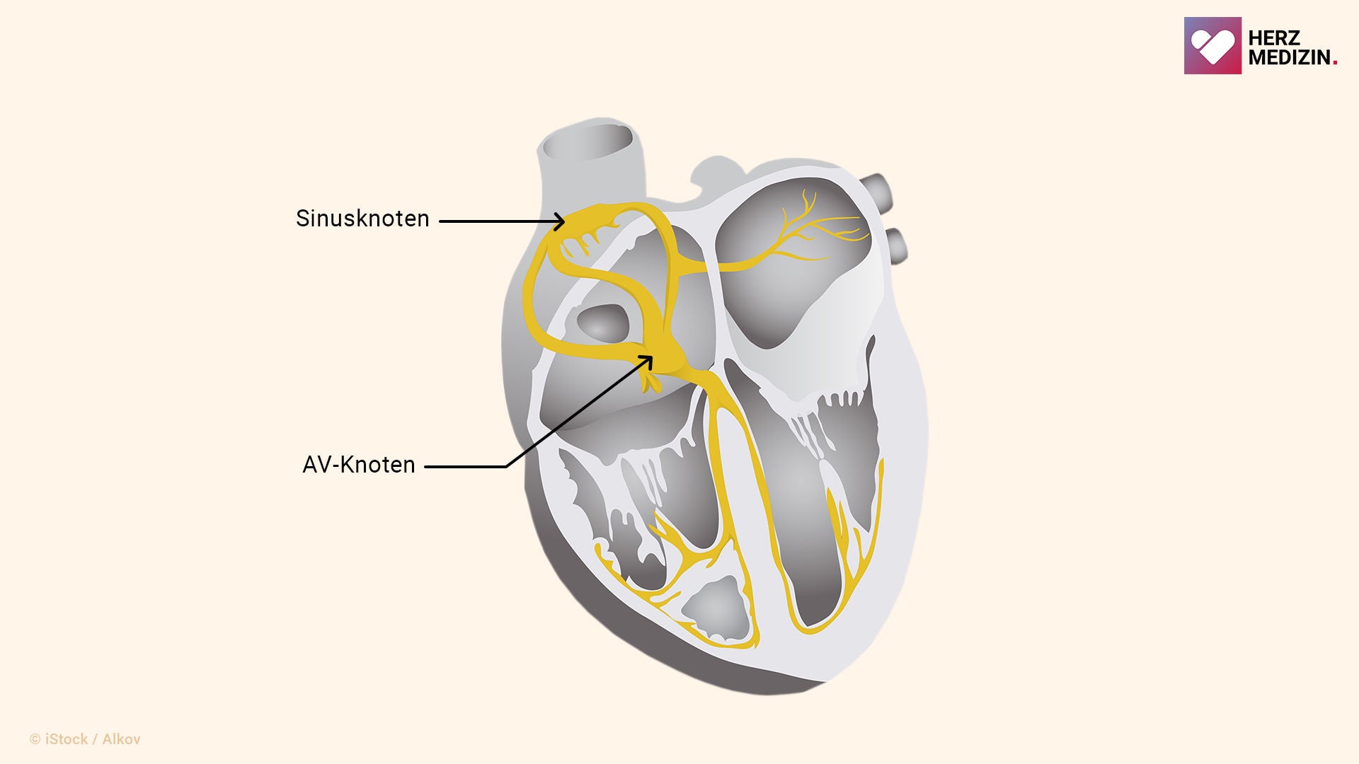 Eine Grafik zeigt die Lage des Sinusknotens und des AV-Knotens im rechten Vorhof des Herzens.