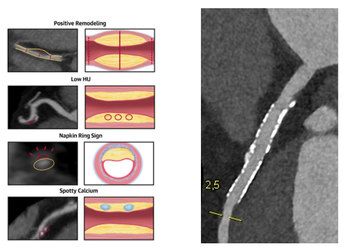 Hochrisikomerkmale zur genaueren Plaque-Charakterisierung / Frei perfundierter Stent in der proximalen LAD mit Ausschluss einer In-Stent-Restenose mittels Photonen-Counter Technologie