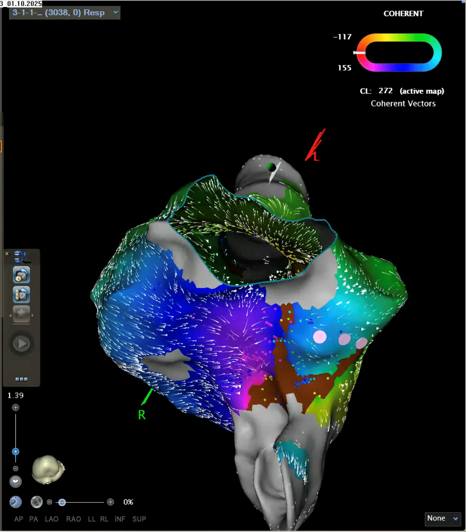Abb. 2: 3D-Map des rechten Atriums in LAO-Kaudaler Ansicht.