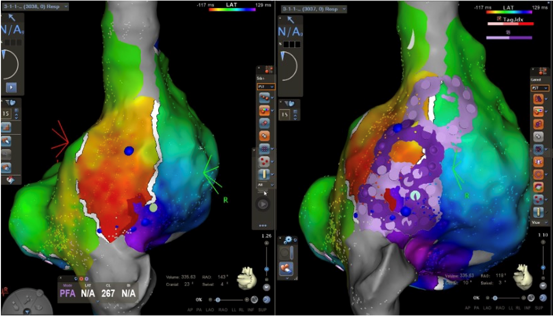 Linke Seite: Kranio-Posteriore Ansicht des rechten Atriums nach Mapping mit dem VLCC-Katheter, Rechte Seite: Darstellung der Ablationsläsionen mit dem zirkulären PFA-Katheter