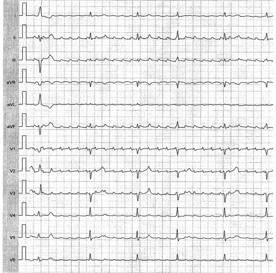 Anfalls-EKG der klinischen Tachykardie