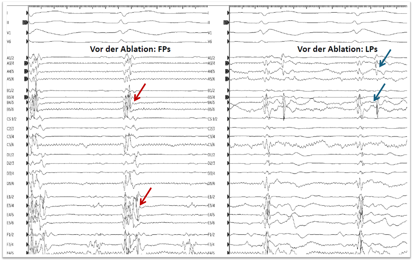 Darstellung der intrakardialen Signale mittels Optrell-Katheter sowie EKG-Ableitungen