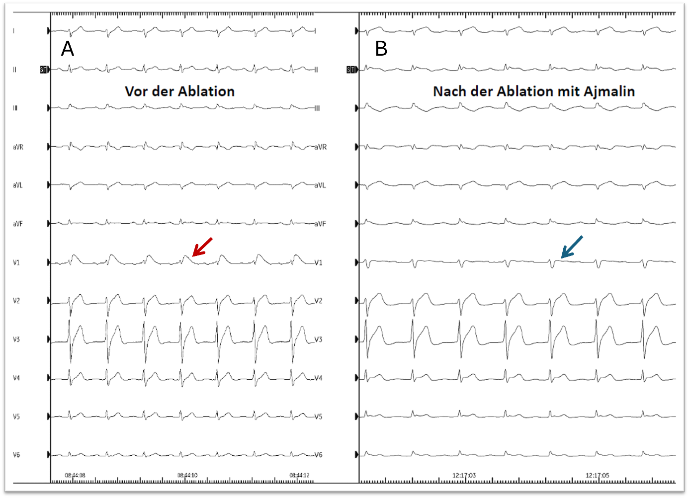 Abbildung 6: 12-Kanal-EKG A) Vor der Ablation mit Markierung des spontanen Typ 1 EKGs (roter Pfeil) und B) Nach der Ablation unter Ajmalinprovokation mit blauem Pfeil kein Typ 1 EKG mehr sichtbar in V1