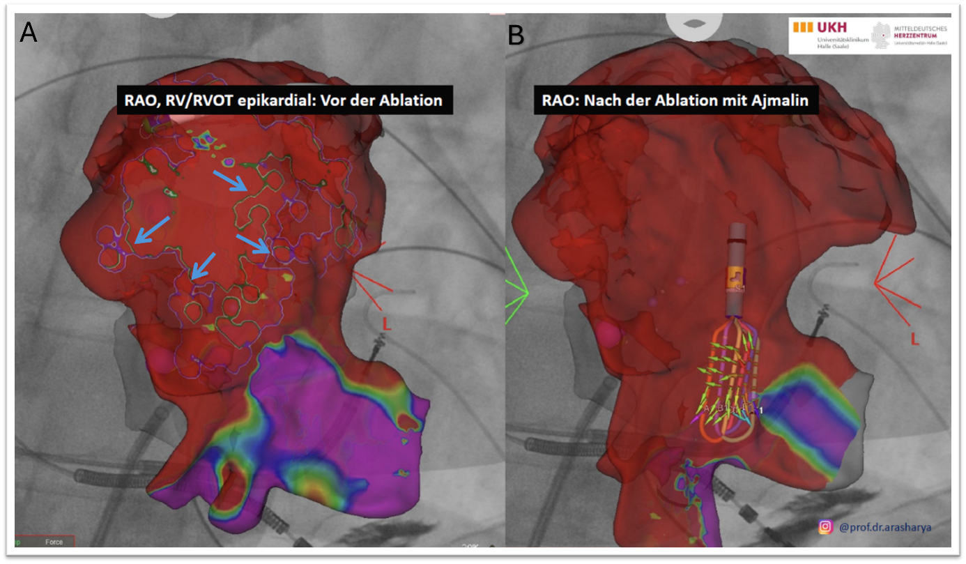 Epikardiale multipolare hochauflösende Substratmaps. A) Ansicht in right anterior oblique (RAO) des rechten Ventrikels (RV) und rechtsventrikulären Ausflusstrakts (RVOT) vor der Ablation.