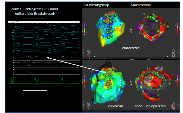 Hochauflösendes, dreidimensionales Aktivierungs- und Substratmap des linken Ventrikels.