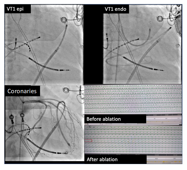 Fluoroskopische Darstellung des Lattice-Tip Ablationskatheters an den endo- sowie epikardialen Positionen, koronarangiographische Darstellung und Monitorauszüge vor- und nach erfolgreicher Katheterablation.