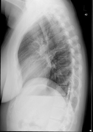 Laterales Röntgenbild des Thorax zeigt die pleurale Lage des ILR