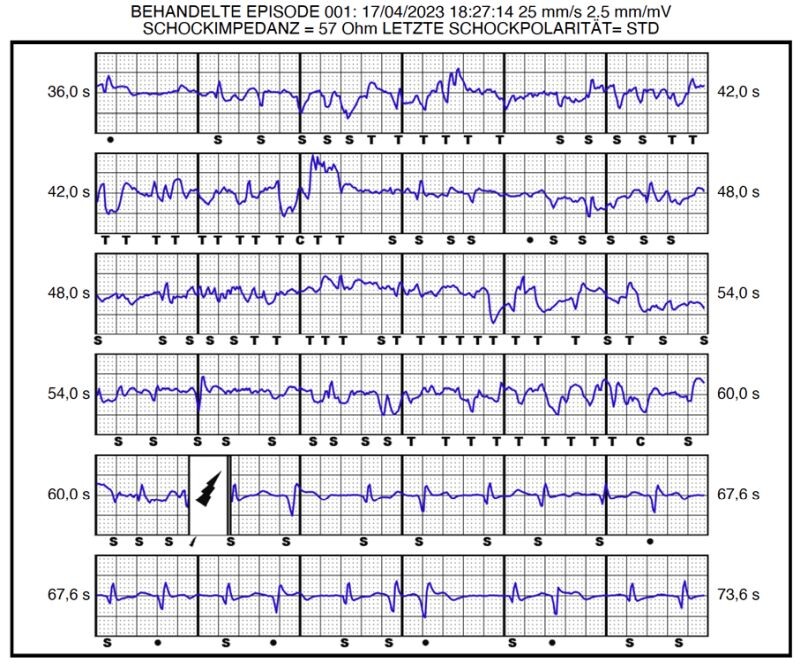 S-ICD-Episode des inadäquaten Schocks im Jahr 2023 (Laufgeschwindigkeit: 25 mm/s). Abkürzungen: STD = Standard; C = Charge; S = Sense; T = Tachy-detektion; • = verworfen. 