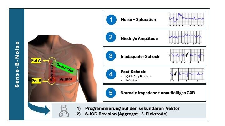 Zusammenfassung der Charakteristiken des Sense-B-Noise als Ursache von inadäquaten Schocks bei S-ICD Patient:innen.