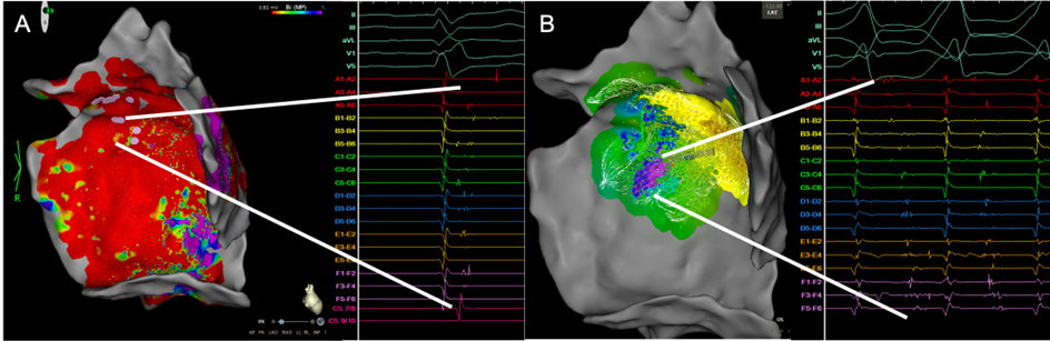3D-elektroanatomisches Map des epikardialen LV mit Ansicht von endokardial/innen.