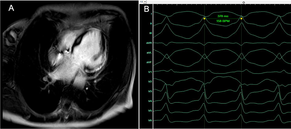 cMRT eines sub-epikardialen Substrats und EKG