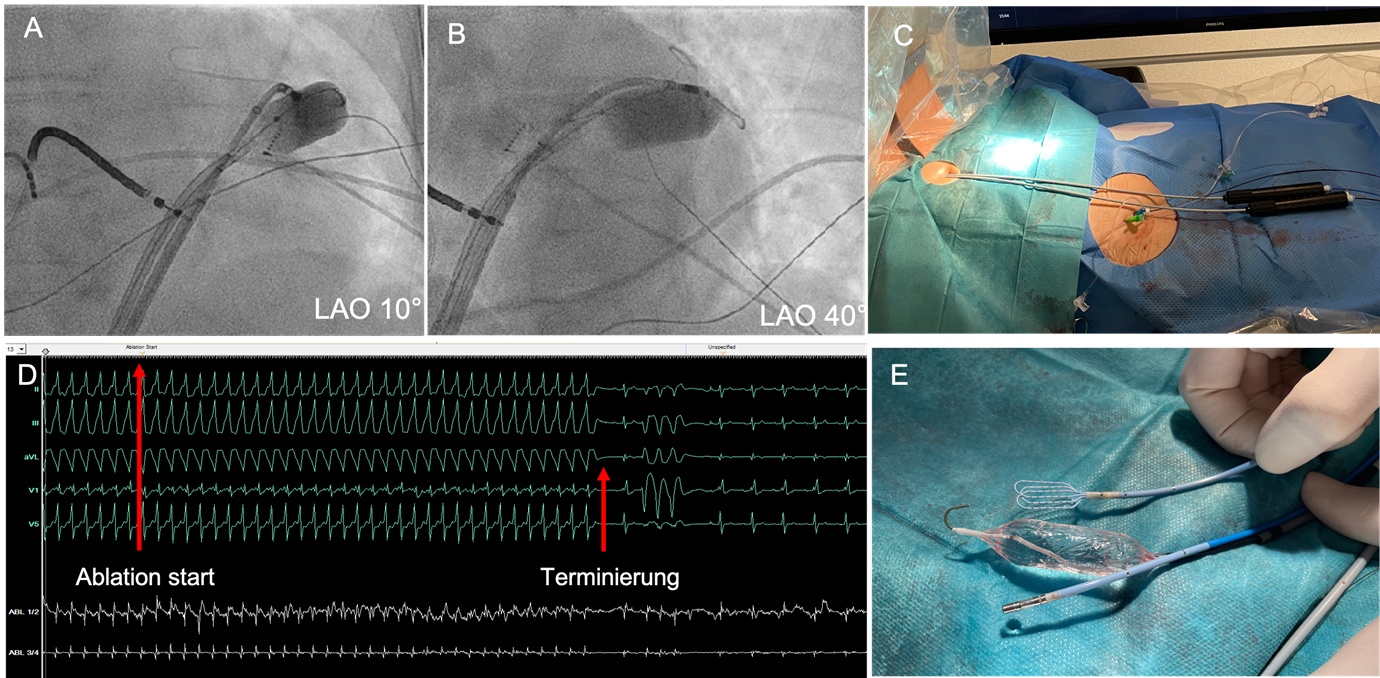 Fluoroskopie von Katheter- und Ballon-Position
