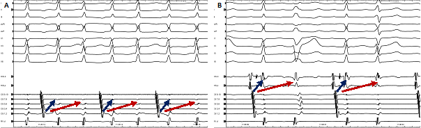 Intrakardiale Signale