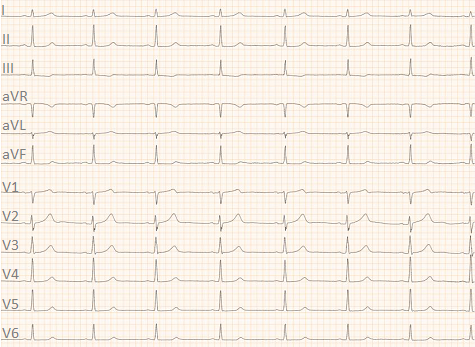 Ruhe-EKG nach Ablation