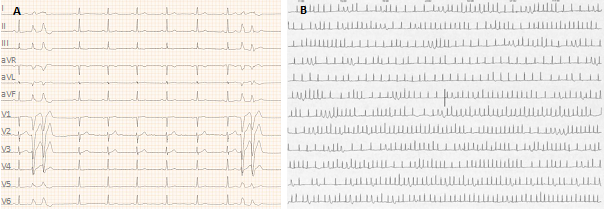 Ruhe-EKG und Holter bei Vorstellung