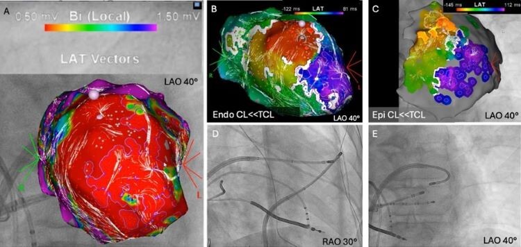(A) Bipolare Voltage-Map des LV; (B) endokardiales und (C) epikardiales Aktivierungs-map der VT; (D) und (E) Fluoroskopische Positionen der Katheter für die bipolare Ablation. CL, Zykluslänge; LAO, left anterior oblique; RAO, right anterior oblique; TCL, Gesamtzykluslänge