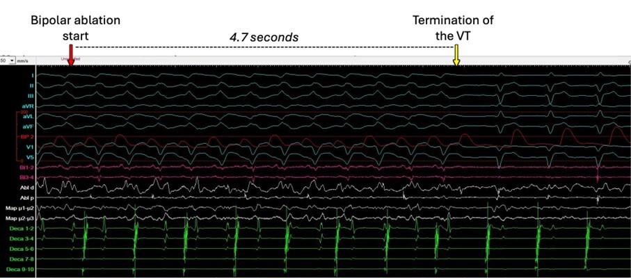 Start der bipolaren Katheterablation und Terminierung der VT nach 4.7 Sekunden. 