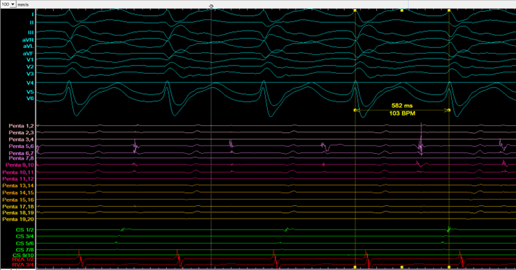 laufende ventrikuläre klinische Tachykardie