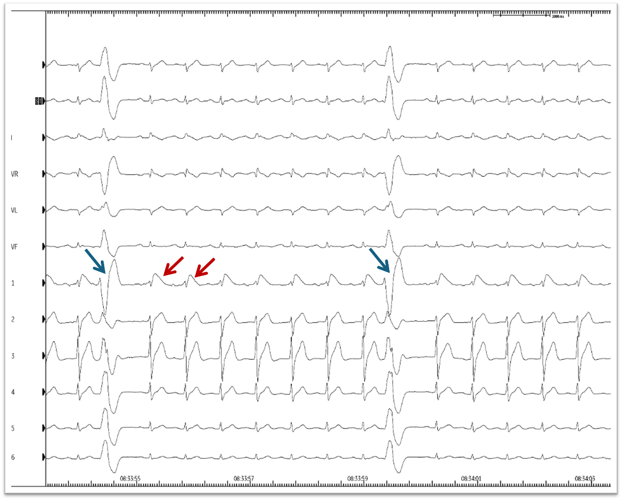 Abbildung 1 Spontanes Brugada Typ 1 EKG, ST-Veränderung mit rotem Pfeil markiert, früh einfallende monomorphe VES mit blauem Pfeil markiert
