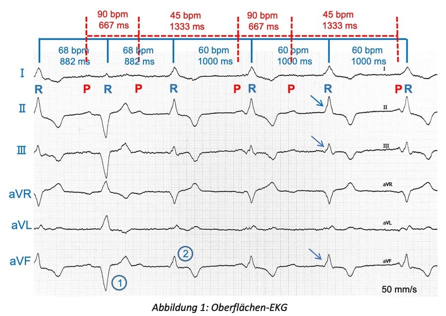1_Oberflaechen-EKG