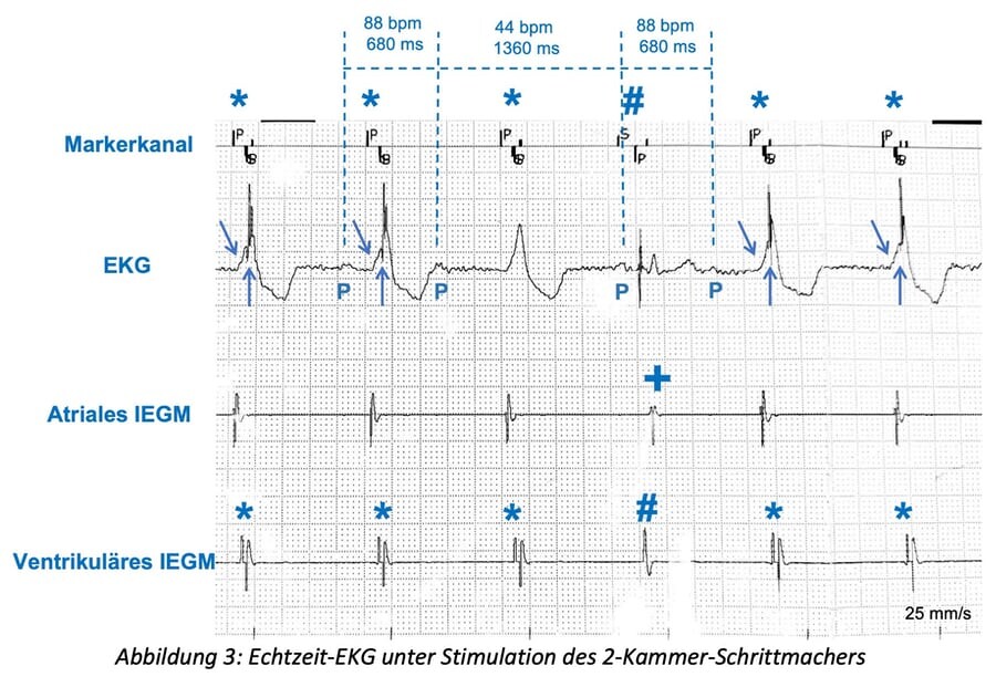 3_Echtzeit-EKG
