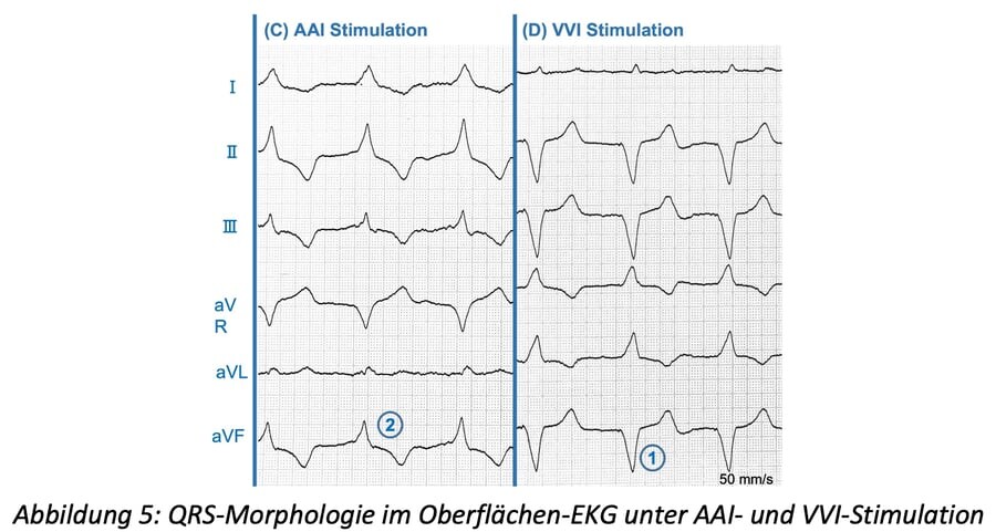 5_Oberflaechen-EKG