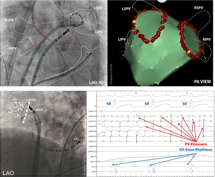 Atrial-Fibrillation