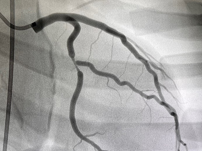 Abb. 3 Bifurkationsstenose