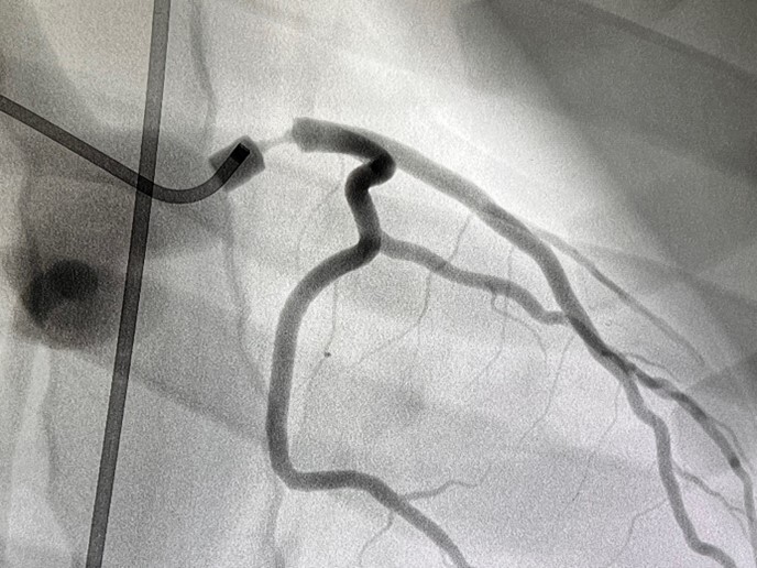 Abb. 4 Hauptstammstenose