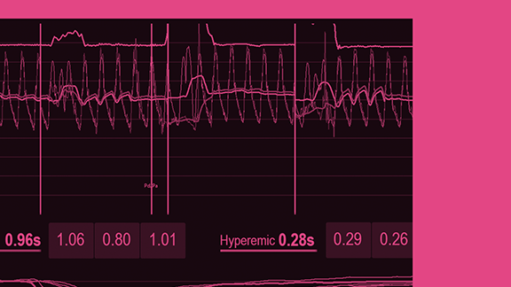 Monitor mit koronarer Untersuchung der Flussreserve und des Widerstands.