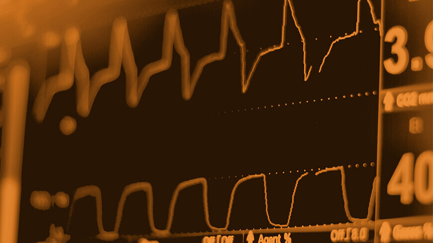 EKG-Monitor in einer intraaortalen Ballonpumpe auf der Intensivstation