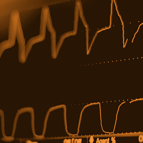 EKG-Monitor in einer intraaortalen Ballonpumpe auf der Intensivstation