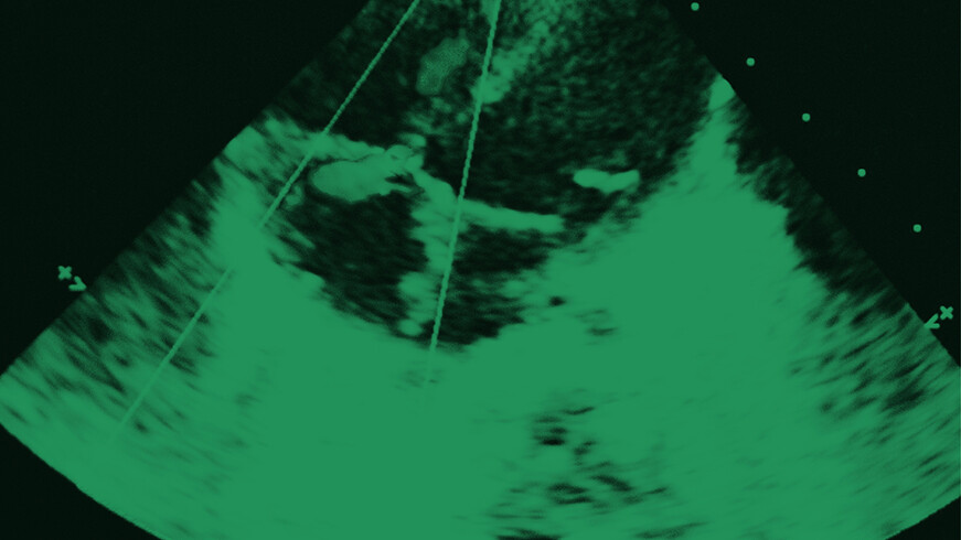 echokardiographie-faustasyan-adobe-stock-213587898-16zu9-871x490