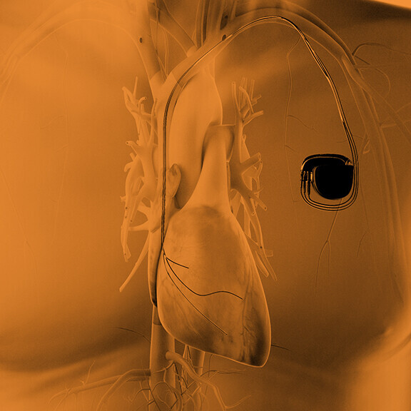 Brust vom Menschen mit einem Herschrittmacherimplantat