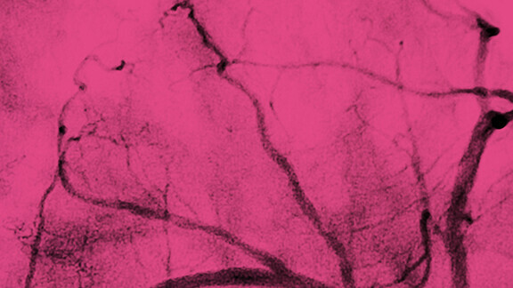 Perkutanen Koronarintervention (PCI) in der Behandlung mit Stents