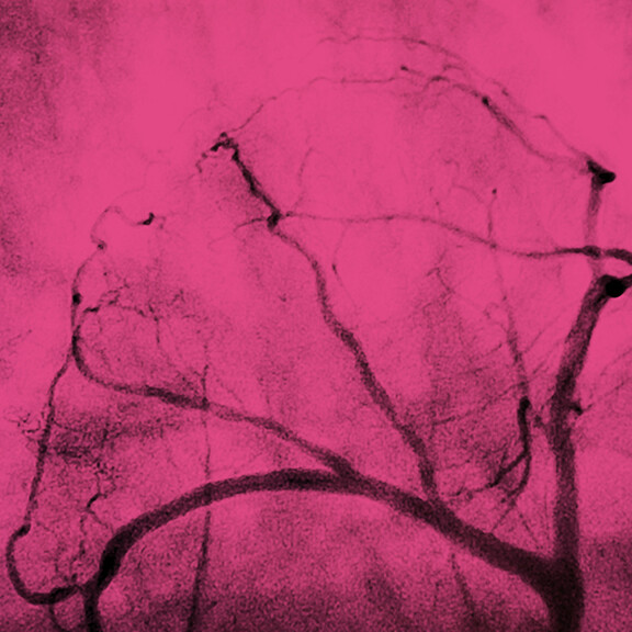 interventionelle-kardiologie-Belezapoy-stock.adobe-543597147-1zu1-576x576