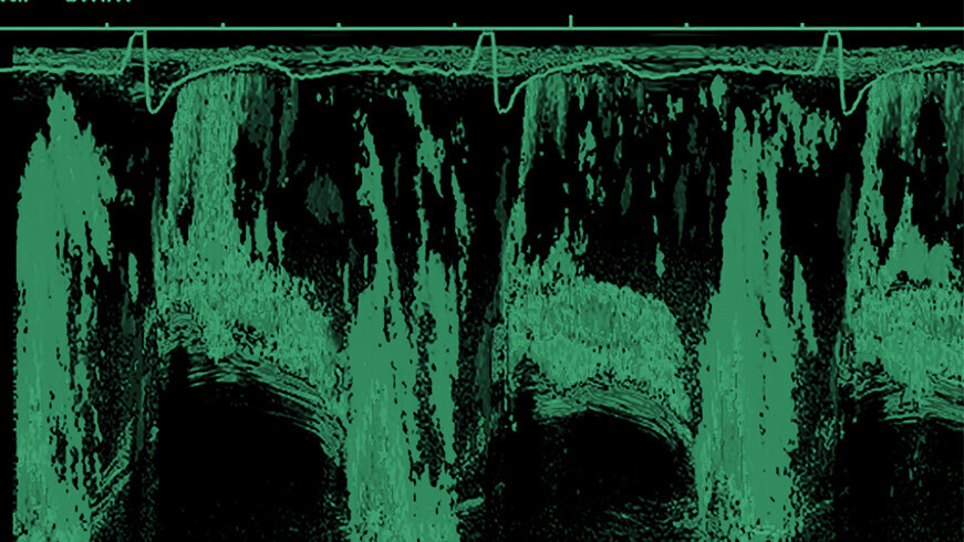 Bild einer Ultraschalluntersuchung des Herzens, die über die Speiseröhre (Ösophagus) durchgeführt wurde.