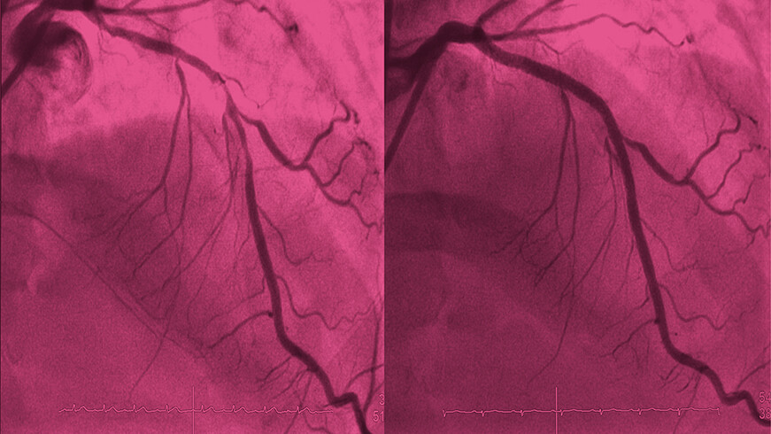 Perkutanen Koronarintervention (PCI) vor und nach der Behandlung