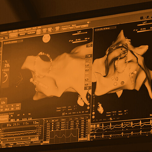 Herz-Elektroanatomiekarte bei Katheterablation bei Vorhofflimmern